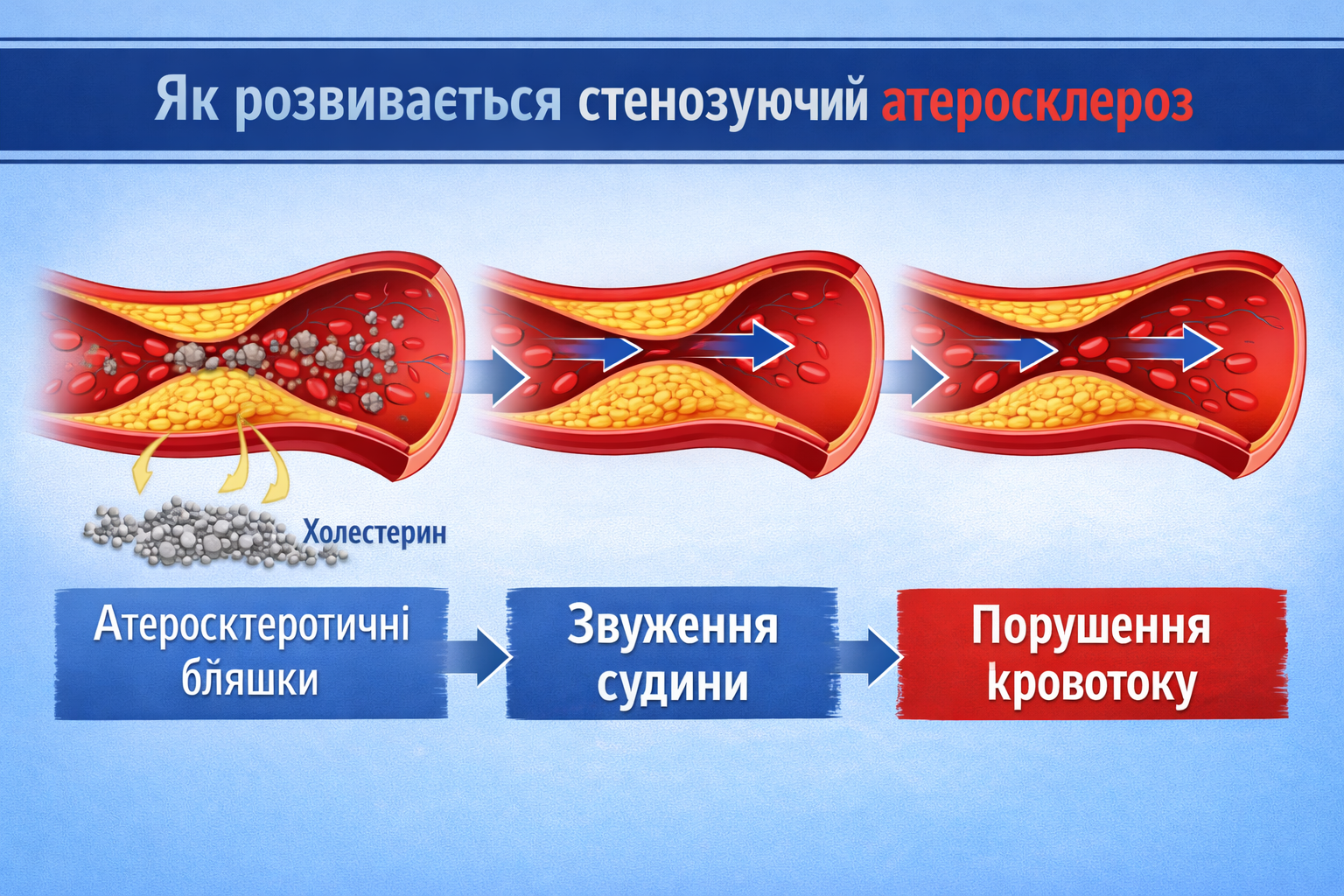 Стенозуючий атеросклероз