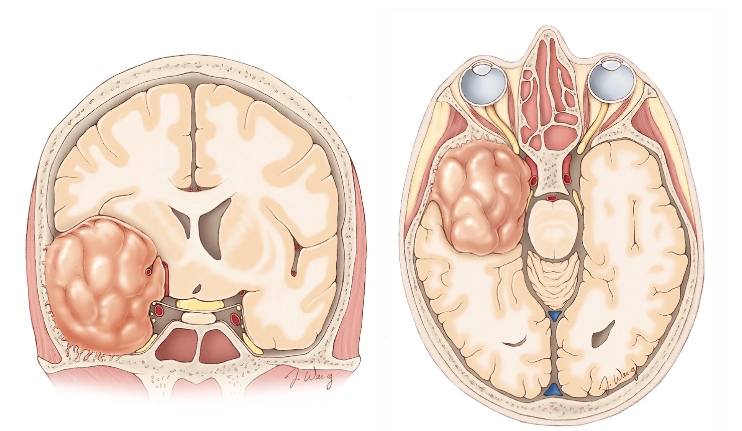 Менінгіома