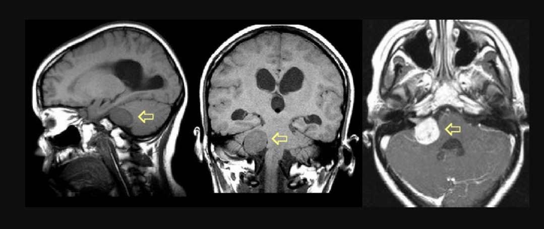 Невринома (вестибулярна шваннома)