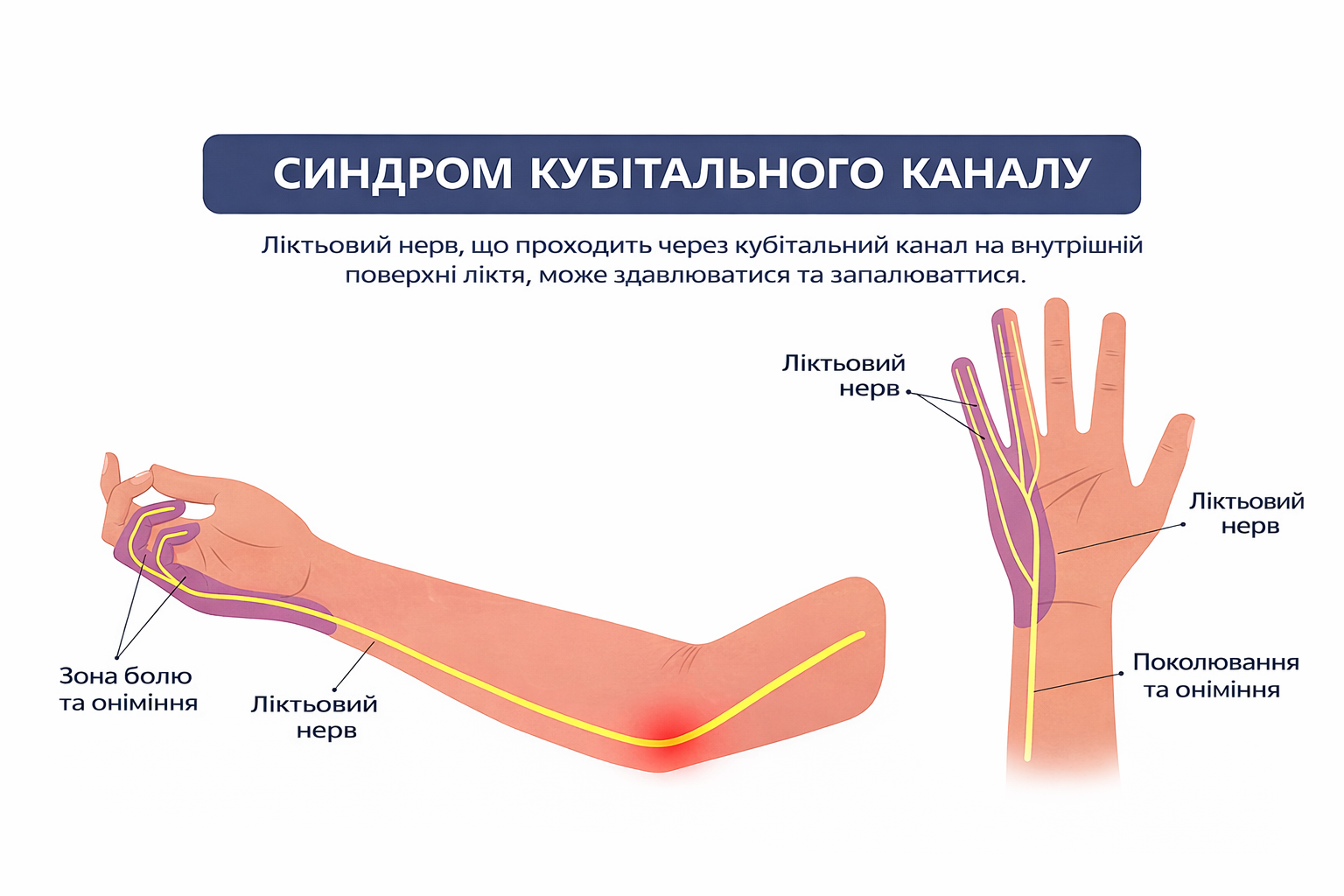 Синдром кубітального каналу