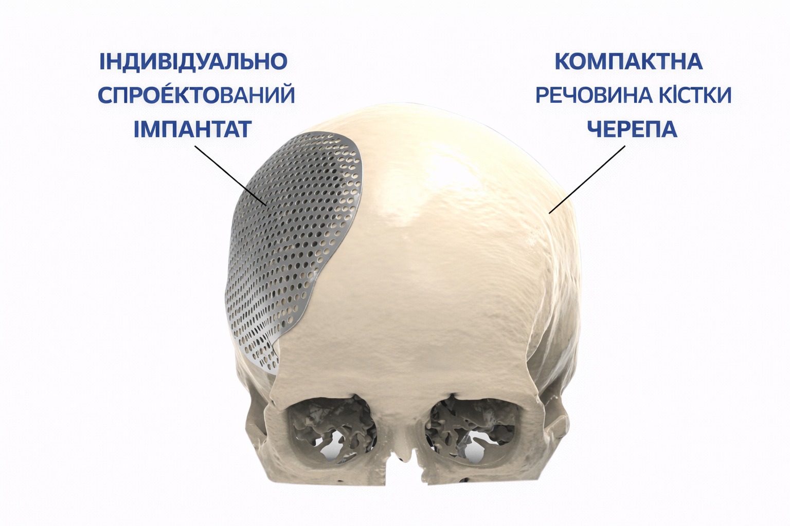 Краніопластика